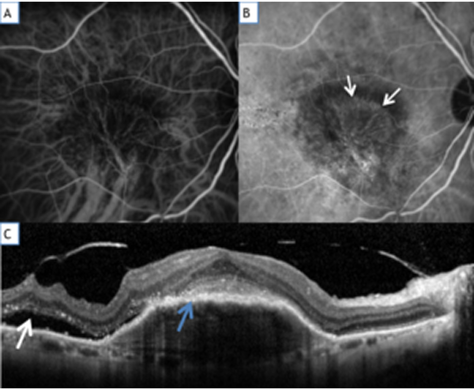 Forme De DMLA dite humide ou exsudative