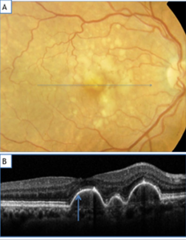 anomalies du fond d'oeil pouvant évoluer vers une DMLA