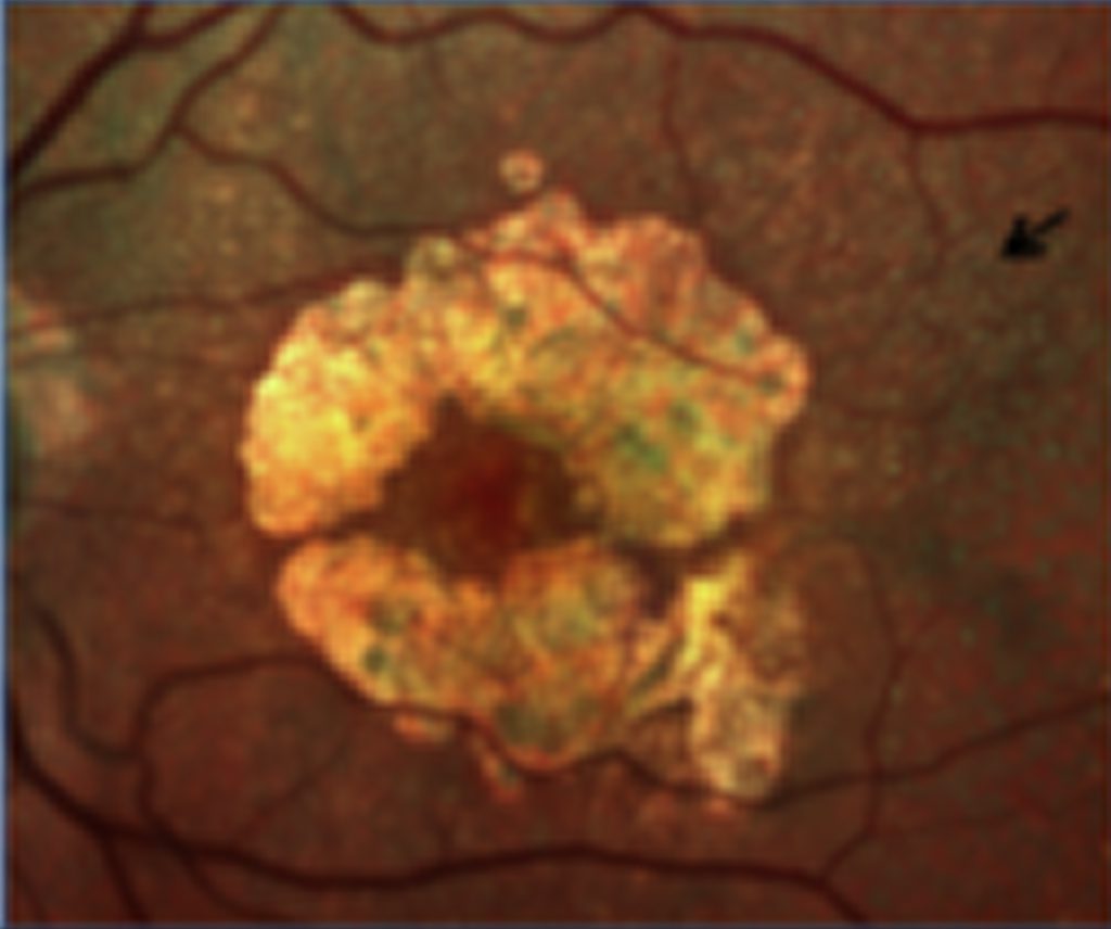 forme de DMLA dite sèche ou atrophique