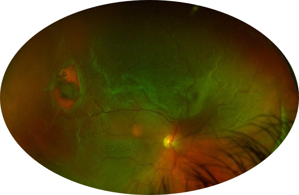 décollement de la rétine : imagerie d'exploration