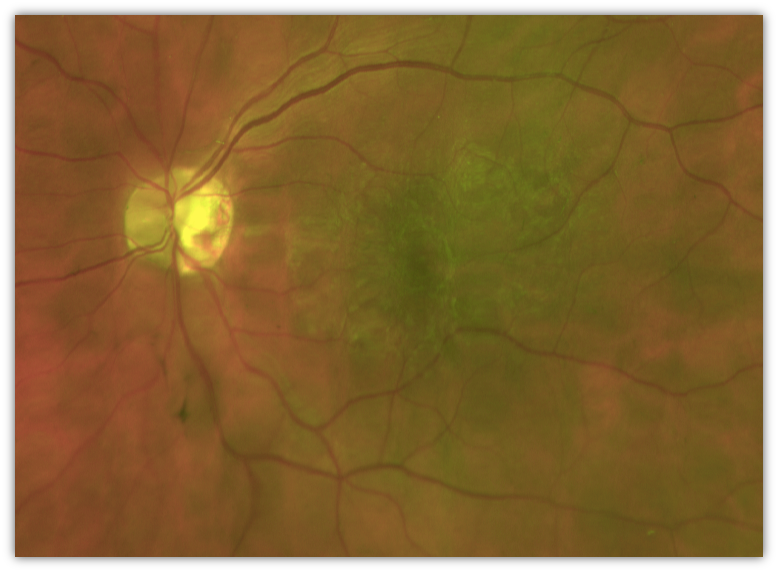 imagerie membrane-epiretinienne
