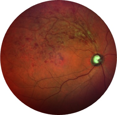 Occlusion d'une branche veineuse rétinienne (OBVR)