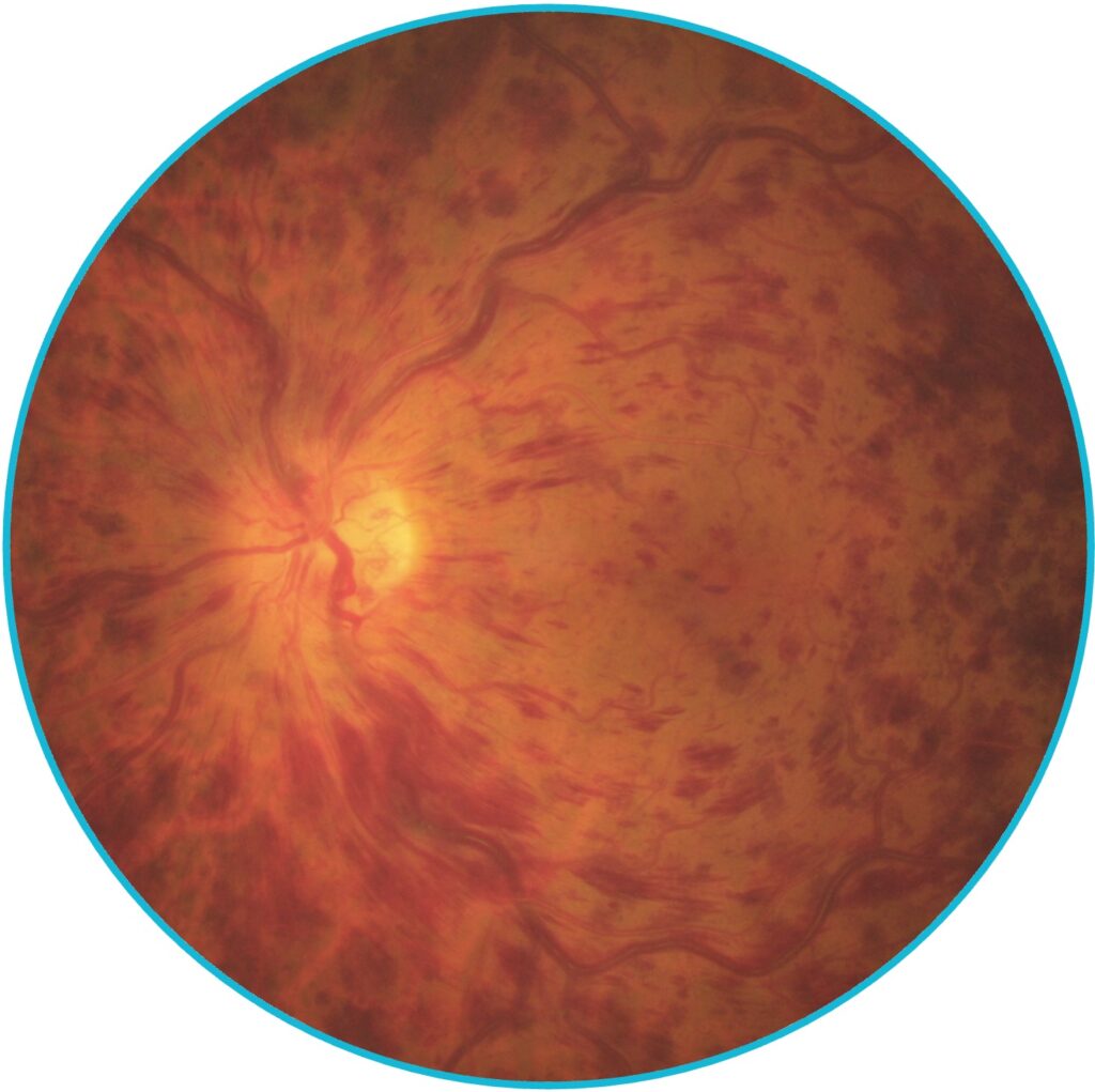 Occlusion de la veine centrale rétinienne (OVCR)